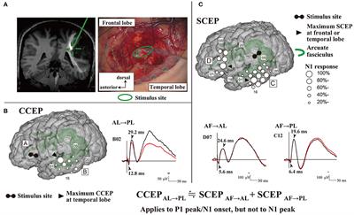 Intraoperative Brain Mapping by Cortico-Cortical Evoked Potential